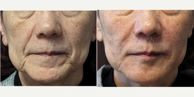65-74 year old woman treated with Liquid Facelift, Juvederm, Restylane, Voluma, Volbella - liquid facelift with filler injection in cheeks, nasolabial folds & marionette lines with Juvederm, Restylane, Voluma, BellaFill, Radiesse, Vollure