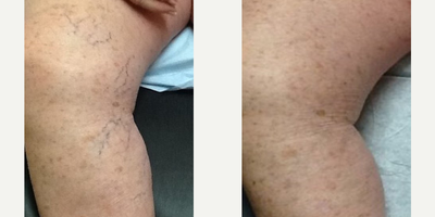 Asclera - Asclera  Leg Vein Treatment