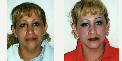 45-54 year old woman treated with Liposculpture - liposuction neck in office under sedation