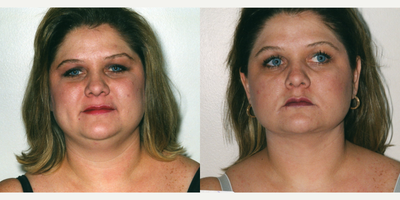 35-44 year old woman treated with Liposculpture - liposuction neck in office under sedation