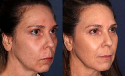45-54 year old woman treated with ResurFX - Before and after ResurFX laser treatment for scar reduction