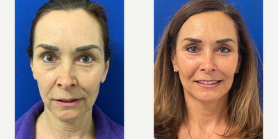 55-64 year old woman treated with Facelift, Neck Lift, Facial Fat Transfer, CO2 Laser - 61 year old 1 & 1/2 years after Facelift, Neck lift, Fat Transfer & Co2 laser