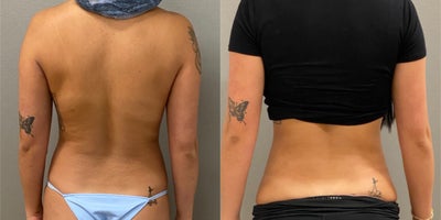 25-34 year old woman treated with Liposuction - 28 yo s/p liposuction abdomen and flanks performed under local anesthesia with sedation in our on site AAAA certified operating suite.