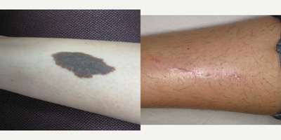 25-34 year old woman treated with Blue Peel - Excision of Giant Naevus from Shin