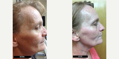 Woman treated with Fractional Laser - Woman treated with Fractional Laser