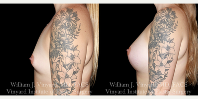 25-34 year old woman treated with Breast Augmentation, Breast Implants, Natrelle Breast Implants - 25-34 year old female treated with a Breast Augmentation with silicone gel breast implants. Patient was unhappy with the size and shape of her breasts and wanted breast implants to enlarge them and give them a more rounded appearance. Dr. Vinyard used Allergan Natrelle Soft Touch Silicone Gel implants to achieve the patient's aesthetic breast goals.