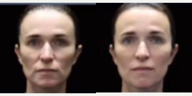 Woman treated with Emface - EMFACE, more lift, less wrinkles, more volume all needle free.