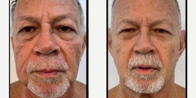 Man treated with Emface - The revolutionary EMFACE treatment is now available in Pasadena. More lift, more volume, less wrinkles, no needles, no pain, no downtime