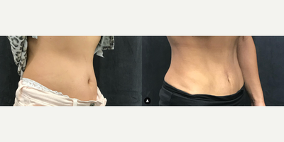 Woman treated with Lipodissolve - What happens when you combine our weight loss treatment (semaglutide), lipodissolve (targeted area fat dissolving), plus diet and exercise? 8.5 weeks until ok.