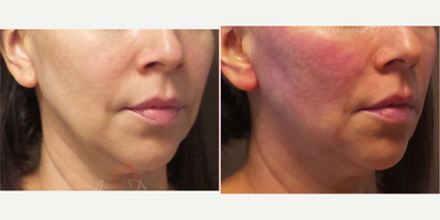 45-54 year old woman treated with Thread Lift, NovaThreads - Mid and lower face rejuvenation with PDO thread lift (cheeks, nasolabial folds, around the mouth and jawline)