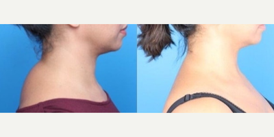 Slim Lipo on back of the neck - 40 year old woman - Patient age: 40, had slim liposuction to remove the buffalo hump on the back of the neck.