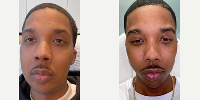 Man treated with Facial - Man treated with Facial