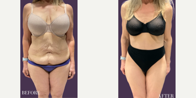 Woman treated with Tummy Tuck - Woman treated with Tummy Tuck. Patient is shown before and 5 months post-op.