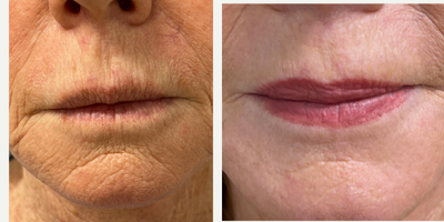 67 year old woman treated with Laser Resurfacing - TRL peri-oral laser resurfacing.