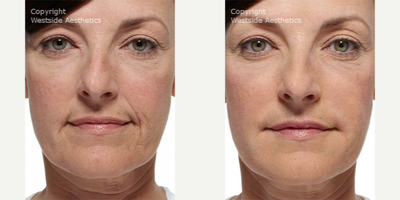 Radiesse Nasolabial Folds and Corners of Mouth - This 57-year-old female patient considered having a lower face lift, but was pleased to discover Dr. Rivkin's noninvasive alternative. Dr. Rivkin injected Radiesse to diminish her nasolabial folds and marionette lines to give her a smoother, more plump appearance.