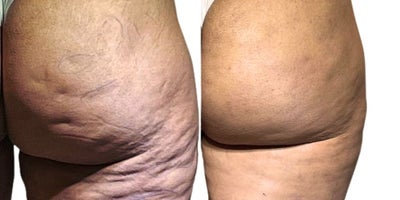 35-44 year old woman treated with Nonsurgical Butt Lift - Incredible transformation with Dr. Roberto Chacur's exclusive Goldincision technique. This innovative procedure effectively treats cellulite, combining collagen biostimulation and fibrous septa detachment for visibly smoother and firmer skin. Natural, long-lasting results that boost self-confidence.