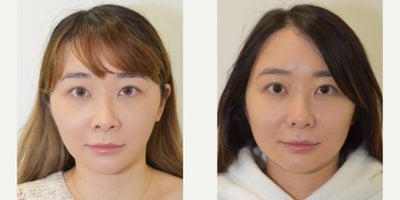 25-34 year old woman treated with Asian Rhinoplasty - Before and after rhinoplasty procedure. Post-operative photos taken at approximately 12 months following surgery.Please note comments have been tuned off for all clinical before/after images as per AHPRA guidelines.All surgery performed by Dr Jason Roth (MED0001185485), Otolaryngology head and neck surgeon, Sydney.Results vary from person to person.Cosmetic surgery is a serious decision.Before proceeding, please seek medical advice from an appropriately qualified medical practitioner.