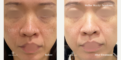 35-44 year old woman treated with Stellar M22 - mid 30s year old treated with Stellar M22 for spot & pigmentation