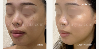 25-34 year old woman treated with Stellar M22 - mid 20s year old treated with Stellar M22 for spot & pigmentation