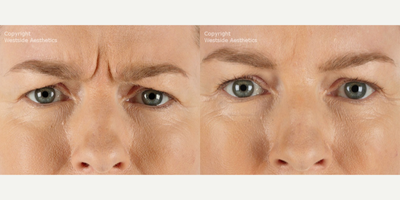 45-54 year old woman treated with Xeomin - This 46-year-old female patient was concerned with her glabellar lines, or 11 lines. Dr. Rivkin injected Xeomin between her eyebrows to diminish her frown lines.