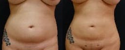 25-34 year old woman treated with Butt Augmentation - The patient underwent a Brazilian Butt Lift (butt augmentation with liposculpting and fat transfer). The combination of the liposculpting and the fat transfer enhance her butt and overall figure. She has a snatched waist and hourglass figure after her Brazilian Butt Lift.