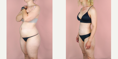 35-44 year old woman treated with Mommy Makeover, Tummy Tuck, Breast Augmentation, Liposuction, Breast Implants - This lovely patient is shown 3 months post-op from mommy makeover consisting of a breast augmentation, abdominoplasty and liposuction. She came to me after hitting a plateau along her journey to a slimmer physique. Oftentimes, diet and exercise are not enough and surgery is needed to tighten muscles and remove excess skin. Her implants were smooth, round silicone and they were placed in a dual-plane to allow a small amount of lift. Here, you can see a huge transformation. Her results are exceptional because she adopted a healthy lifestyle after surgery to continue to improve upon her results.