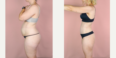 35-44 year old woman treated with Mommy Makeover, Tummy Tuck, Breast Augmentation, Liposuction, Breast Implants - This lovely patient is shown 3 months post-op from mommy makeover consisting of a breast augmentation, abdominoplasty and liposuction. She came to me after hitting a plateau along her journey to a slimmer physique. Oftentimes, diet and exercise are not enough and surgery is needed to tighten muscles and remove excess skin. Her implants were smooth, round silicone and they were placed in a dual-plane to allow a small amount of lift. Here, you can see a huge transformation. Her results are exceptional because she adopted a healthy lifestyle after surgery to continue to improve upon her results.