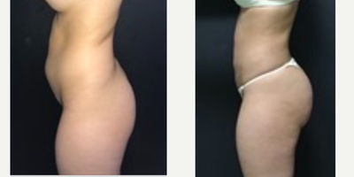 35-44 year old woman treated with Brazilian Butt Lift Revision - Mini BBL 6 weeks
