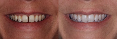 Closing Space Between 2 Front Teeth - 
	Chairside bonding was used in a single visit to close the gap between this patient's front teeth.
