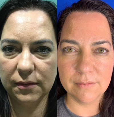 35-44 year old woman treated with Liquid Facelift - Liquid facelift performed with fillers to the cheeks (Radiesse) and under eyes (Belotero), and Xeomin to the forehead and crows feet.