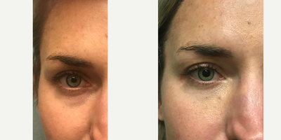 25-34 year old woman treated with Dark Circles Under Eye Treatment - Patient came in complaining about looking tired.