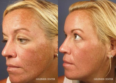 Woman treated with VI Peel - Woman treated with VI Peel