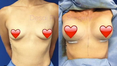 Woman treated with Breast Augmentation - Woman treated with Breast Augmentation with 415 High Profile Gummy Bear Implants