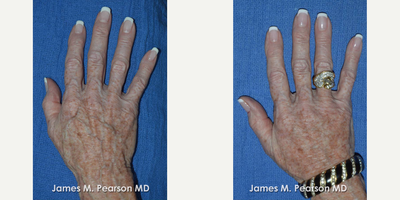 65-74 year old woman treated with Radiesse - Hand Rejuvenation, Non surgical. Treatment with Radiesse filler can minimize the appearance and prominence of age-associated veins and tendons in the hand.
