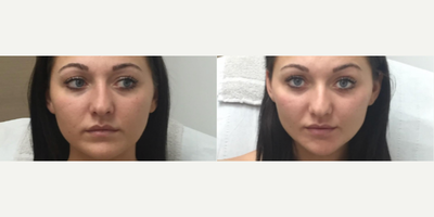 25-34 year old woman treated with Teosyal - 25-34 year old woman treated with Teosyal