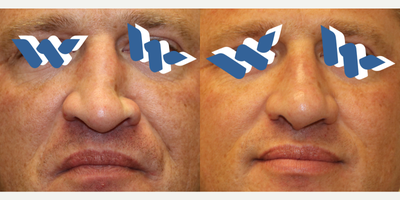 25-34 year old man treated with Rhinoplasty - Septorhinoplasty after multiple fractures over many years.Slight Saddle correction along the bridge of the noseimproved projection and tip angle