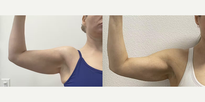 Woman treated with Morpheus8 - Woman treated with Morpheus8