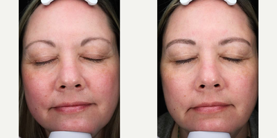 Woman treated with Morpheus8 - Woman treated with Morpheus8