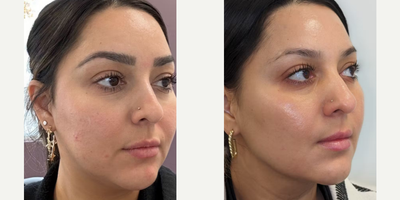 Woman treated with Microneedling - Woman treated with Microneedling