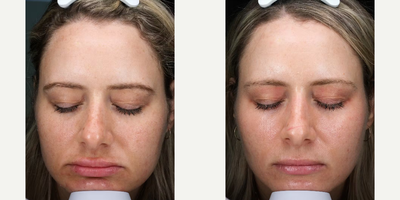 Woman treated with Fractora RF - Woman treated with Fractora RF
