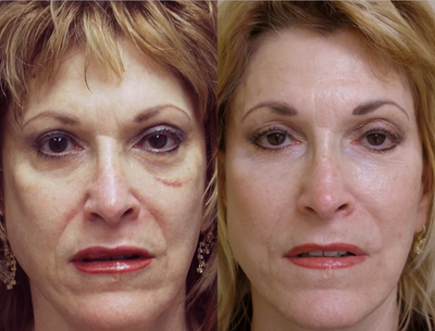 Sculptra injections - 	65 years old with volume loss as the primary cause of the signs of aging. Treatment was with Sculptra. The injections were entirely subcutaneously except for the lower eyelids which were sub-orbicularis muscle. The post injection photo is at one year. Seven ml of saline was used as the diluent. She had 8 ml injected in each of two sessions.