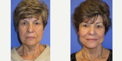 75 and up year old woman treated with Facelift , neck lift and lower eye rejuvenation - 75 year old female seeking facial and lower lid rejuvenation. She underwent a facelift, neck lift and lower eye rejuvenation under IV anesthesia. Note the brighter and more rested natural appearance.