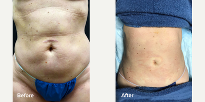45-54 year old woman treated with Tickle Lipo - FDA approved Tickle Lipo is the very latest in fat removal and body sculpting. When combined with Renuvion, a new, unique alternative to traditional tummy tucks and other excisional body sculpting procedures, Tickle Lipo and Renuvion Body Lift will help you achieve a sculpted, firm body with less expense and downtime.