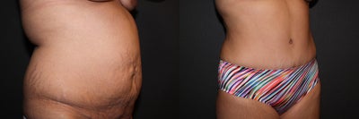 Laser Liposuction - Abdomen, Flanks & Bra Line - 	Laser Liposuction - Abdomen, Flanks and Bra Line