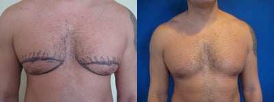 Laser Liposuction - Gynecomastia - Laser Liposuction - Gynecomastia