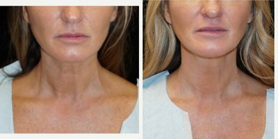 35-44 year old woman treated with Nonsurgical Neck Lift - Amazing MINIMALLY INVASIVE result with neck and lower face Renuvion for skin tightening