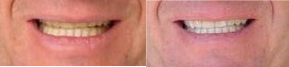 Lumineers - Before and after Lumineers