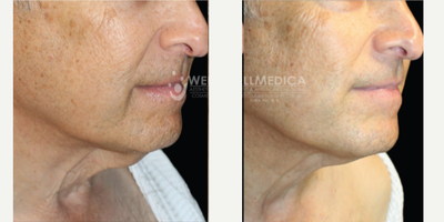 65-74 year old man treated with Venus Freeze - 6 Venus Freeze Treatments of lower face area/ chin area