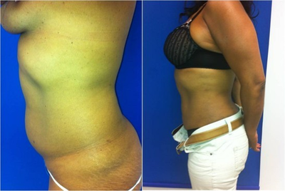 Laser Liposuction - 
	Laser Liposuction
