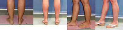 Calf Liposculpture  - Liposuction of the calves was performed to sculpt and shape them by Jon A Perlman, MD FACS.
